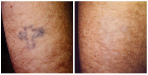 Laser tattoo removal- before and after