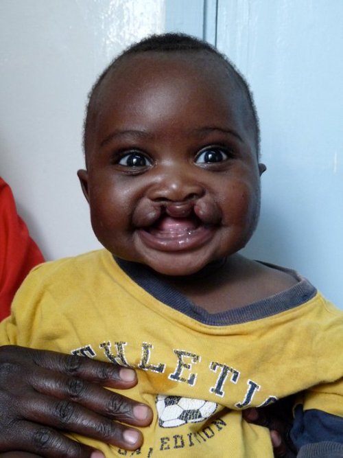 bilateral cleft lip. has a ilateral cleft lip.